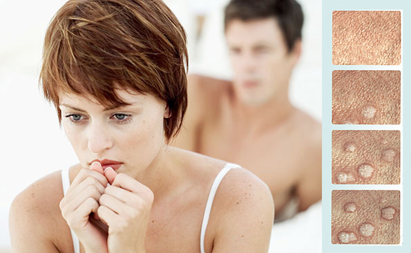 Devo me preocupar com verrugas genitais - blog pitacos e achados a